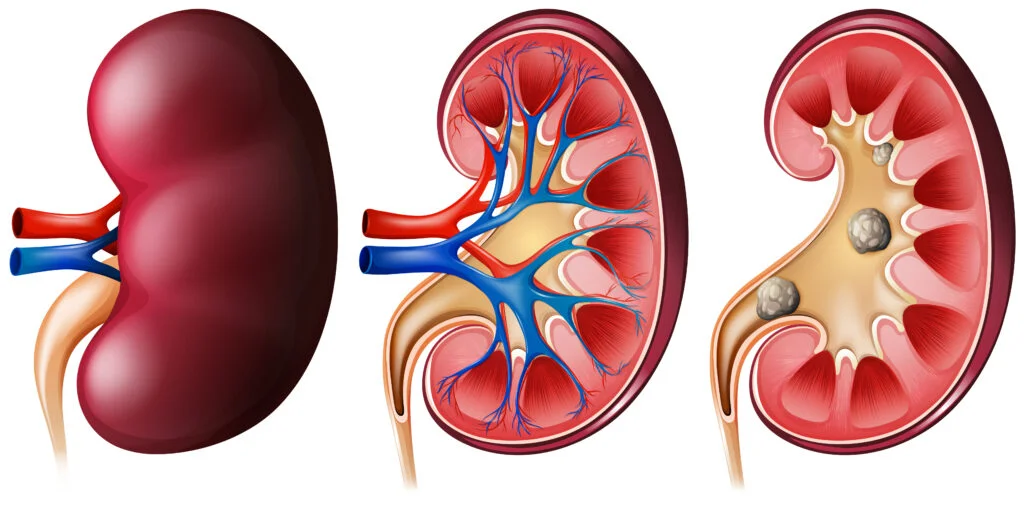 Causes, symptoms, and prevention of kidney stones.