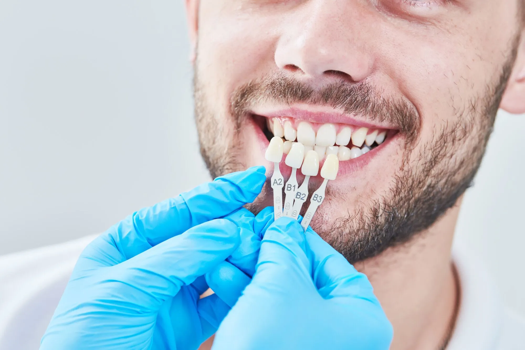Tips for selecting the best dentist for veneers